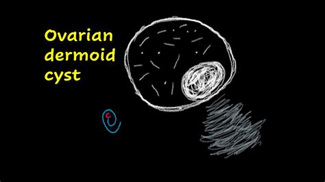 Ovarian Dermoid Cyst Youtube