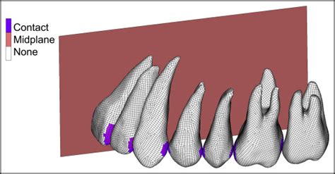 Numeric Simulation Model For Long Term Orthodontic Tooth Movement With Contact Boundary