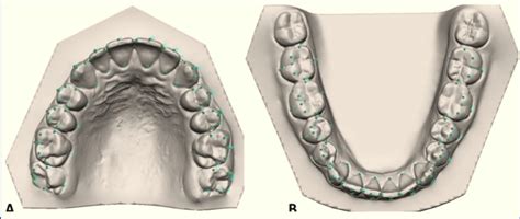 3d View Of Occlusal Plane Used As A Reference For All Measurements