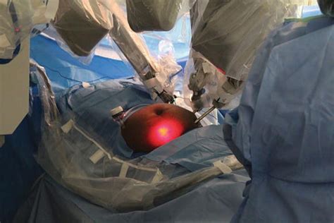 Robotic Ventral Hernia Repair Intechopen