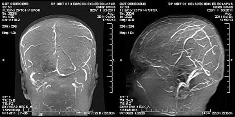 Dr Balaji Anvekar Frcr Dural Sinus Thrombosis Chronic