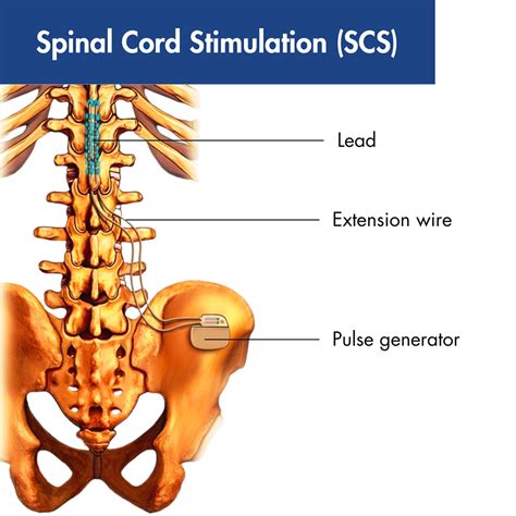 Spinal Cord Stimulation (SCS) in Madison, WI