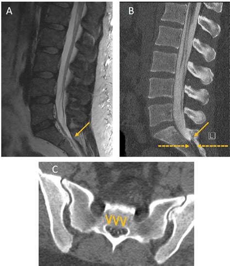 Magnetic Resonance Mr And Computed Tomography Ct Myelogram Images Download Scientific