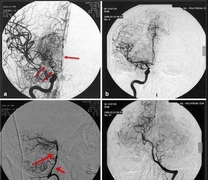 (RCVS), Reversible cerebral vasoconstriction syndrome - Mohammad ...