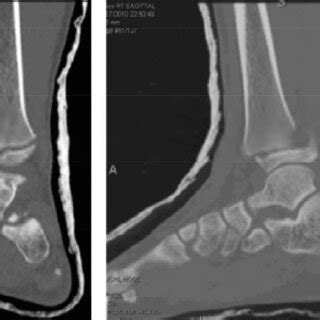 Coronal A And Sagittal B Computed Tomography Scans Of The Left