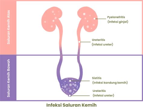 Ciri Infeksi Saluran Kemih Yang Berat Dan Cara Mengobatinya Bocah