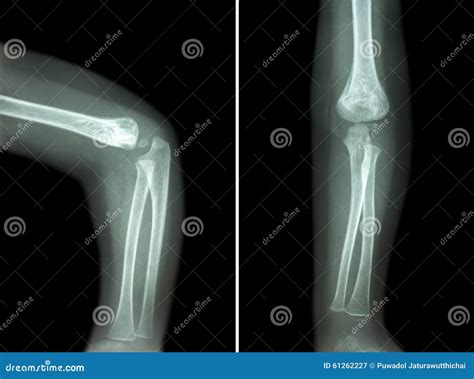 X Ray Elbow Normal