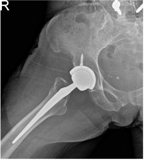 Case Study Bilateral Total Hip Replacement In Year Old