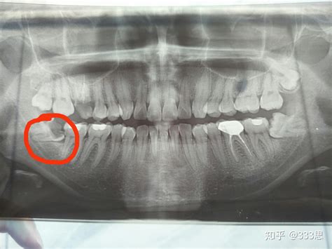 拔智齿拔智齿，要注意，小心细节打败拔牙后的脸肿和发烧！！！ 知乎