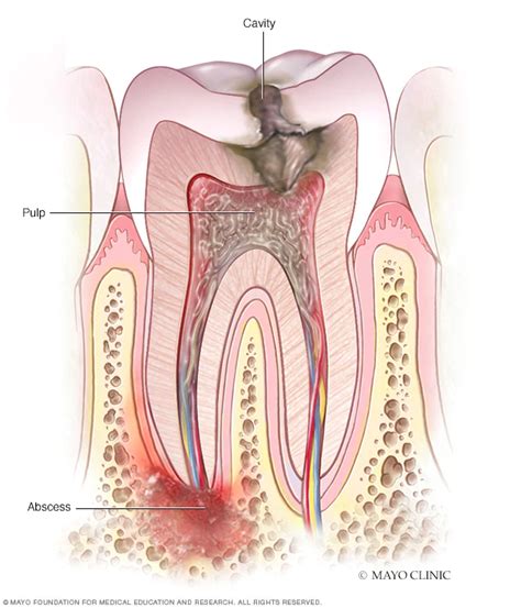 Tooth abscess symptoms and causes – Artofit