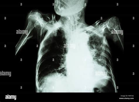 Pulmonary Tuberculosis With Acute Respiratory Failure Film Chest X