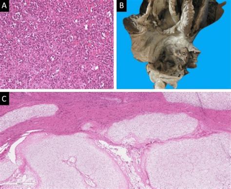 BREAKING COVID 19 Increases Risk Of Heart Tumors Including Cardiac