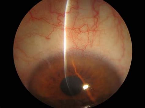 Figure 3 From Relapsed Ocular Squamous Surface Neoplasia Treated With