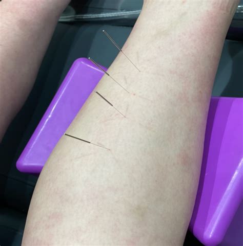 The Difference Between Dry Needling Acupuncture Watsonia Podiatry