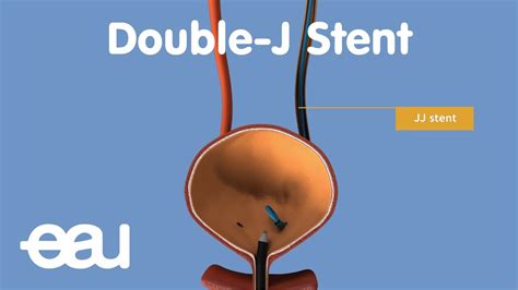 How To Deal With A Kidney Stent - Percutaneous Nephrolithotomy Pcnl My ...