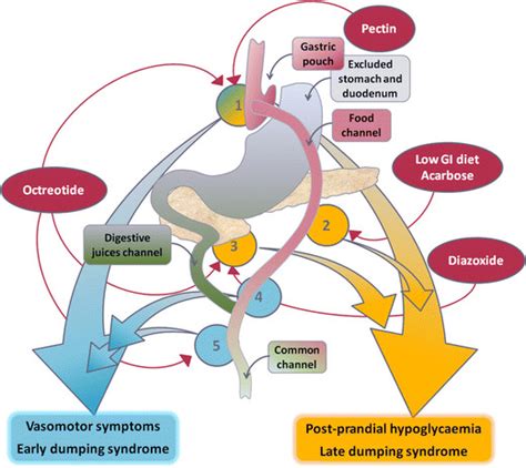 Physiology Of Dumping Syndrome