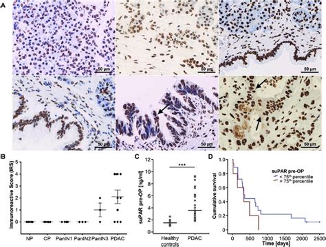 Upar Expression And Circulating Levels Of Supar In Pancreatic