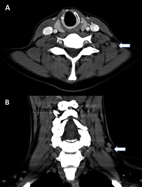 Axial Ct Scan Of The Neck Demonstrating Multiple Cervical Lymph Nodes Images And Photos Finder