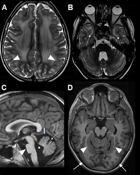 Epilepsy In LAMA2 Related Muscular Dystrophy A Systematic Review Of