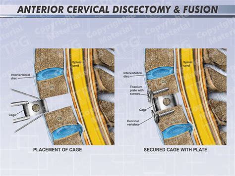 Cervical Discectomy And Fusion