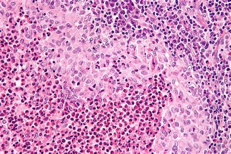 Langerhans Cell Histiocytosis — Diagnosis Classification And Prognosis