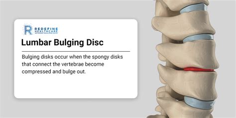 Lumbar Bulging Disc Treatment in New Jersey | Back Pain Doctors Specialists