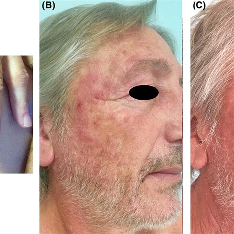 A Erythematous Papules On The Dorsum Of The Hands And Inflammation Of Download Scientific