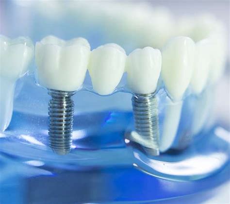 Dental Implants Miami FL South Florida Dental Arts Replace Missing