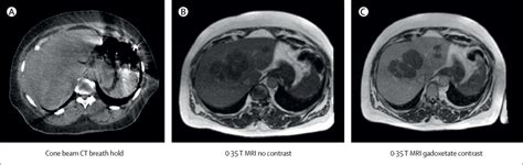 Mri Guided Adaptive Radiotherapy For Liver Tumours Visualising The