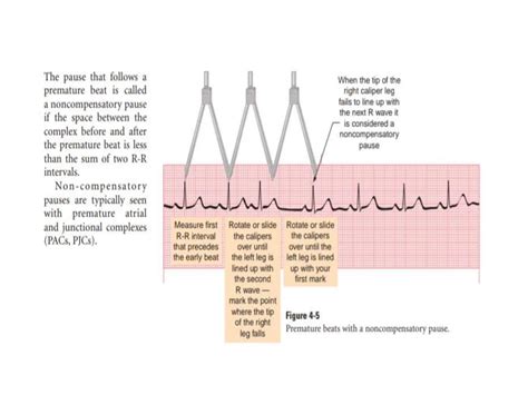 ATRIAL DYSRHYTHMIAS AND HOW TO INTERPRET IN ECG PPT