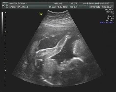 22 Week Ultrasound Girl