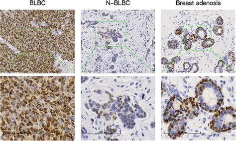 SOX10 Promotes The Malignant Biological Behavior Of Basal Like Breast