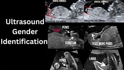 Ultrasound Gender Determination How To Identify How Accurate Youtube