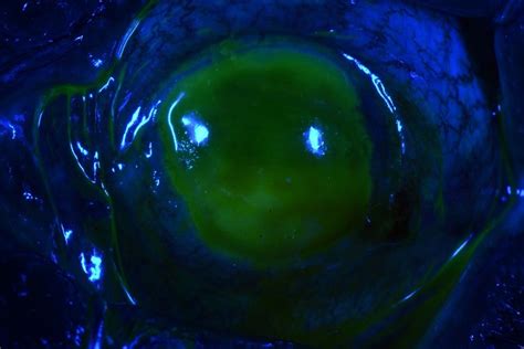 Microbial Keratitis Fluorescein Stained Cornea Illuminated Flickr