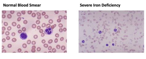 Anemias Microcytic And Hypochromic Flashcards Quizlet