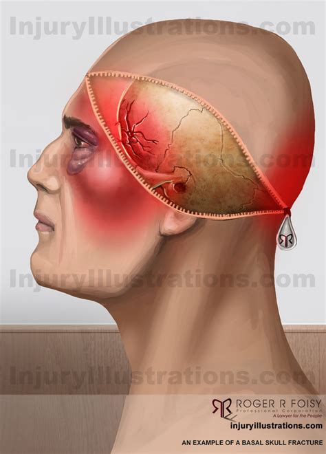 Basilar Skull Fracture Diagram