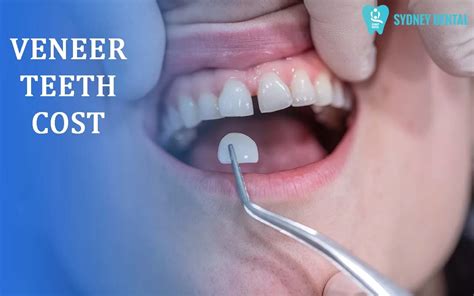 Veneer Teeth Cost Factors Estimates And More Sydney Top Dental