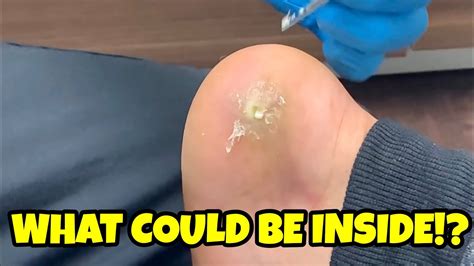 Incision And Drainage Of A Creamy Heel Abscess With Debridement Of