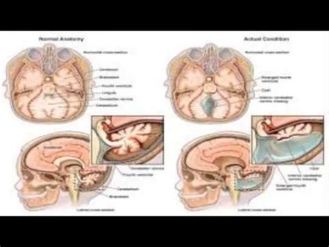 Dandy Walker Syndrome – Neuro1Hub