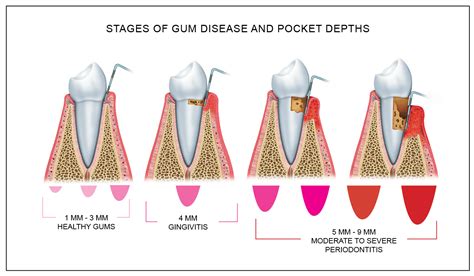 Periodontal Disease Grand Rapids | Near Me | Great Lakes Periodontics