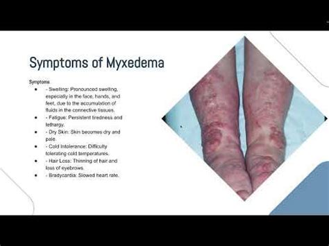 Myxedema Presentation - YouTube