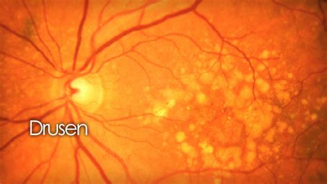 Drusen | small deposits in the retina associated with macular degeneration