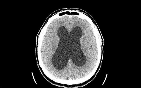 Гидроцефалия головного мозга на КТ cимптомы водянки головного мозга