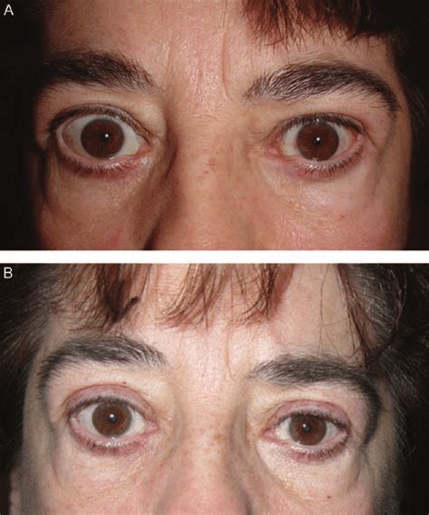 A Pre Operative Photograph Of Patient With Bilateral Mm Upper Lid