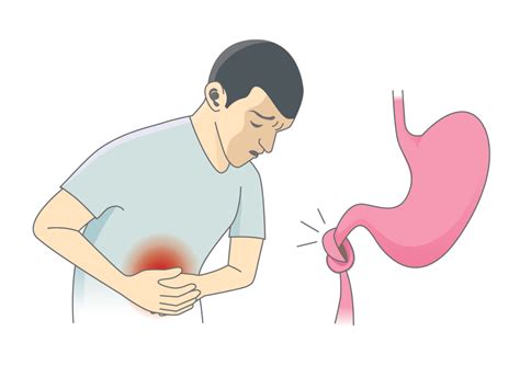 Le Syndrome De Lintestin Irritable SII