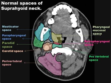 Pin By Dr Abuaiad On Brainandhead And Neck Radiology Imaging Medical Anatomy Diagnostic Imaging