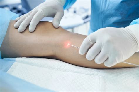 What to Expect from Minimally Invasive Vein Surgery: A Comprehensive Guide