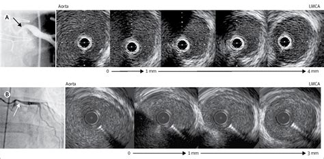 Intravascular Imaging In Coronary Artery Disease The Lancet