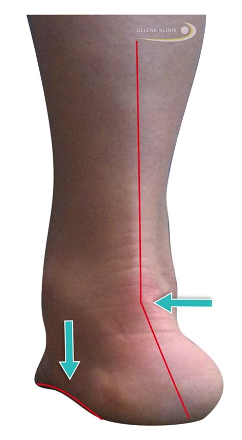 Knick Senkfuß Hohlfuß Plattfuß bei Kindern und Erwachsenen Laufen
