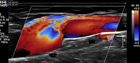 B: SFJ on colour Doppler showing reflux on Valsalva. DISCUSSION Colour ...